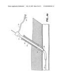 SHEATH-MOUNTED ARTERIAL PLUG DELIVERY DEVICE diagram and image