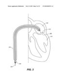 METHODS, DEVICES, AND KITS FOR TREATING MITRAL VALVE PROLAPSE diagram and image