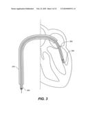 METHODS, DEVICES, AND KITS FOR TREATING MITRAL VALVE PROLAPSE diagram and image