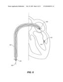 METHODS, DEVICES, AND KITS FOR TREATING MITRAL VALVE PROLAPSE diagram and image