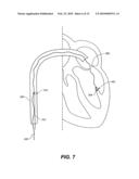 METHODS, DEVICES, AND KITS FOR TREATING MITRAL VALVE PROLAPSE diagram and image