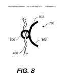 METHODS, DEVICES, AND KITS FOR TREATING MITRAL VALVE PROLAPSE diagram and image