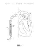 METHODS, DEVICES, AND KITS FOR TREATING MITRAL VALVE PROLAPSE diagram and image