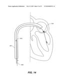 METHODS, DEVICES, AND KITS FOR TREATING MITRAL VALVE PROLAPSE diagram and image