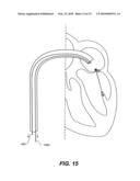 METHODS, DEVICES, AND KITS FOR TREATING MITRAL VALVE PROLAPSE diagram and image