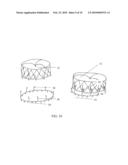 ANNULOPLASTY WITH ENHANCED ANCHORING TO THE ANNULUS BASED ON TISSUE HEALING diagram and image