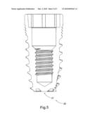 Dental implant diagram and image