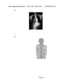 METHODS OF SCREENING FOR COMPOUNDS FOR USE AS MODULATORS OF LEFT-RIGHT ASYMMETRY IN SCOLIOTIC SUBJECTS AND FOR MONITORING EFFICACY OF AN ORTHOPAEDIC DEVICE diagram and image