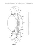 METHOD AND APPARATUS FOR REDUCING INTRAOCULAR PRESSURE diagram and image