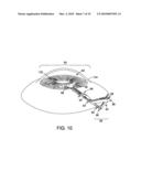 METHOD AND APPARATUS FOR REDUCING INTRAOCULAR PRESSURE diagram and image