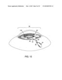 METHOD AND APPARATUS FOR REDUCING INTRAOCULAR PRESSURE diagram and image