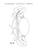 METHOD AND APPARATUS FOR REDUCING INTRAOCULAR PRESSURE diagram and image