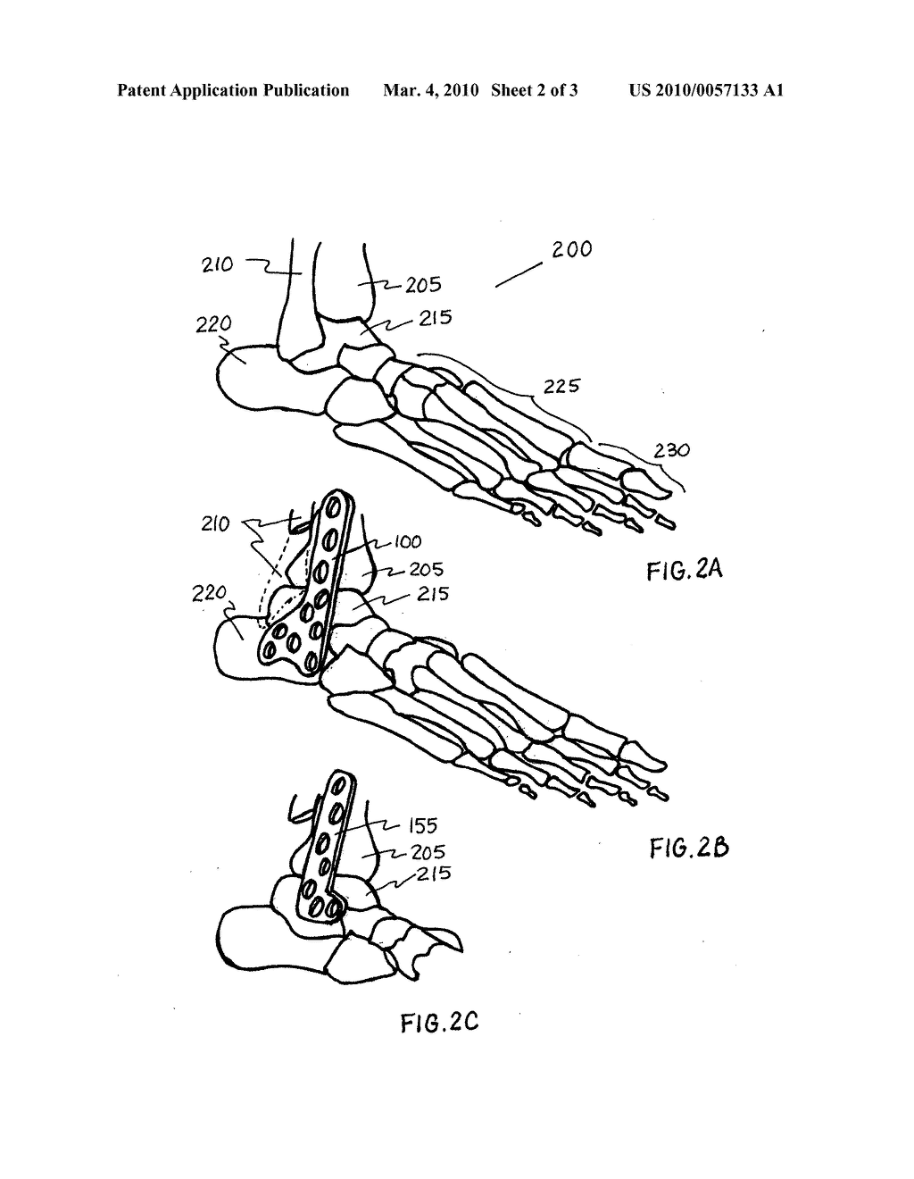 Tibia-talus-calcaneus (T-T-C) locking plate - diagram, schematic, and image 03