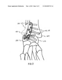 Tibia-talus-calcaneus (T-T-C) locking plate diagram and image