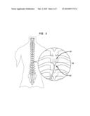 METHODS AND APPARATUS FOR SPINAL CORD STIMULATION USING EXPANDABLE ELECTRODE diagram and image