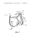 FLEXIBLE HEART VALVE AND ASSOCIATED CONNECTING BAND diagram and image