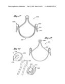 FLEXIBLE HEART VALVE AND ASSOCIATED CONNECTING BAND diagram and image