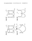 FLEXIBLE HEART VALVE AND ASSOCIATED CONNECTING BAND diagram and image