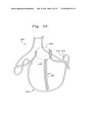 FLEXIBLE HEART VALVE AND ASSOCIATED CONNECTING BAND diagram and image