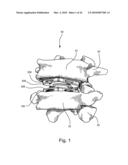 Universal Spinal Disc Implant System diagram and image