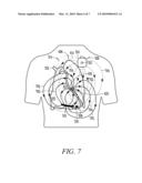 MONITORING FLUID IN A SUBJECT USING AN ELECTRODE CONFIGURATION PROVIDING NEGATIVE SENSITIVITY REGIONS diagram and image