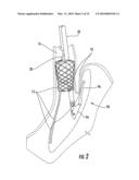 MEDICAL DEVICE FIXATION TOOL AND METHOD OF FIXATION OF A MEDICAL DEVICE diagram and image