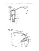 KNOTLESS SUTURE ANCHOR FOR SOFT TISSUE REPAIR AND METHOD OF USE diagram and image