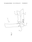 Internal Joint Stabilizer Device, System, and Method of Use diagram and image