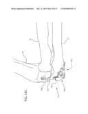 Internal Joint Stabilizer Device, System, and Method of Use diagram and image