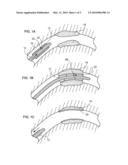 ENDOPROSTHESES diagram and image