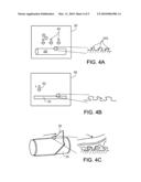 ENDOPROSTHESES diagram and image