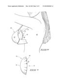 Bra Pad and Method of Relieving Breast Engorgement diagram and image