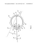 ORTHOVOLTAGE RADIOTHERAPY diagram and image