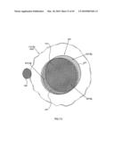 ORTHOVOLTAGE RADIOTHERAPY diagram and image