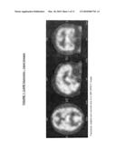 AUTOMATIC INTERPRETATION OF 3-D MEDICINE IMAGES OF THE BRAIN AND METHODS FOR PRODUCING INTERMEDIATE RESULTS diagram and image