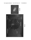 ENHANCED RESOLUTION OF TUMOR METASTASIS USING A SKIN FLAP MODEL diagram and image