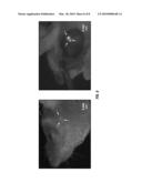 ENHANCED RESOLUTION OF TUMOR METASTASIS USING A SKIN FLAP MODEL diagram and image