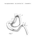 ANASTOMOTIC DEVICE diagram and image