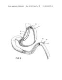 ANASTOMOTIC DEVICE diagram and image