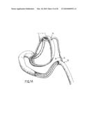 ANASTOMOTIC DEVICE diagram and image