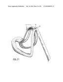 ANASTOMOTIC DEVICE diagram and image