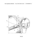 ANASTOMOTIC DEVICE diagram and image