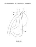 ANASTOMOTIC DEVICE diagram and image