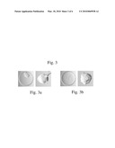 GLAUCOMA SURGERY diagram and image