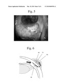 GLAUCOMA SURGERY diagram and image