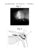 GLAUCOMA SURGERY diagram and image