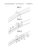 METHOD FOR REDUCING EMBOLI FORMATION diagram and image