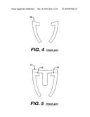 Concave Resurfacing Prosthesis diagram and image