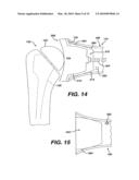 Concave Resurfacing Prosthesis diagram and image