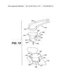 Concave Resurfacing Prosthesis diagram and image